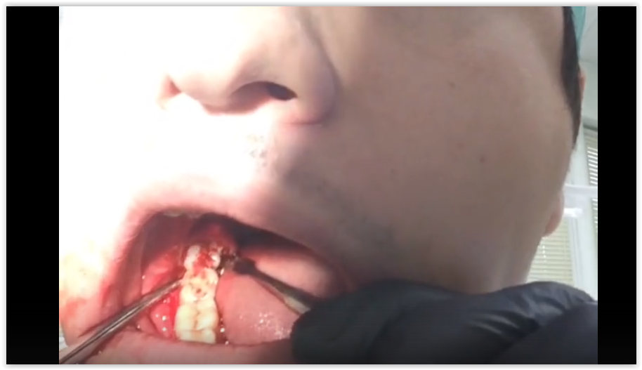 Стоматолог из Сургута снял на видео операцию по удалению собственного зуба