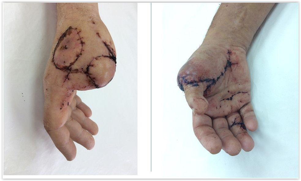 Хирурги томской ОКБ избавили мужчину от инвалидности, пересадив на кисть руки палец со стопы 2