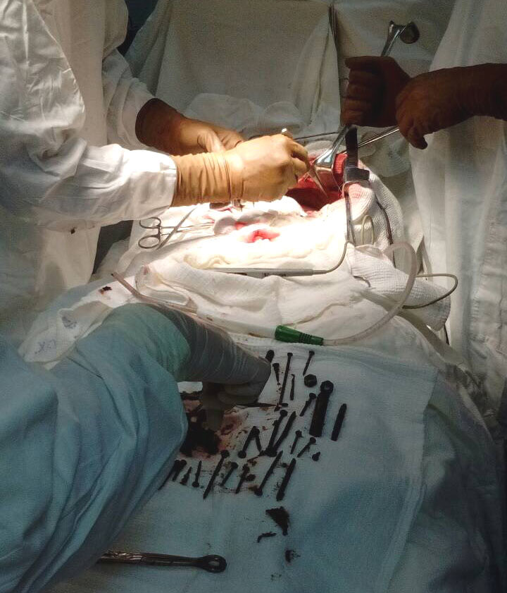 В Бурятии хирурги удалили 150 гвоздей из желудка пенсионерки 2