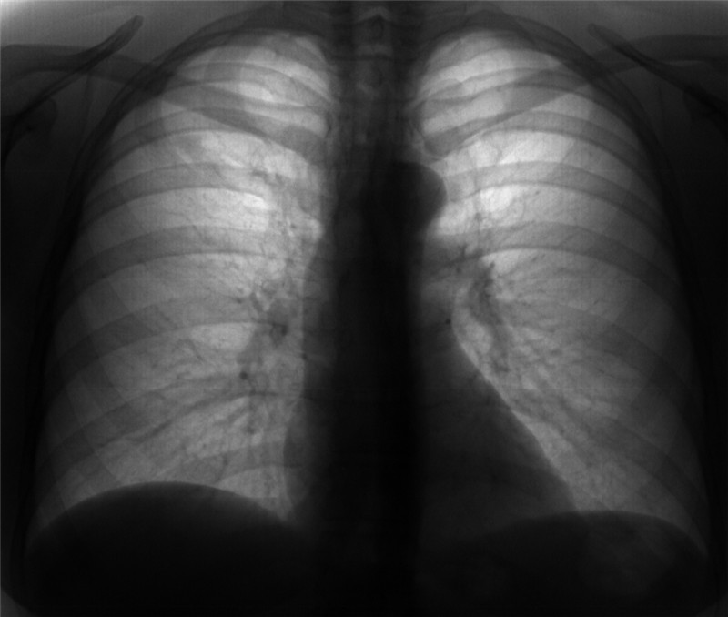 Снимок легких при туберкулезе фото