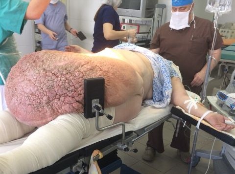 Хирурги удалили женщине 60-килограммовый живот, который рос 26 лет