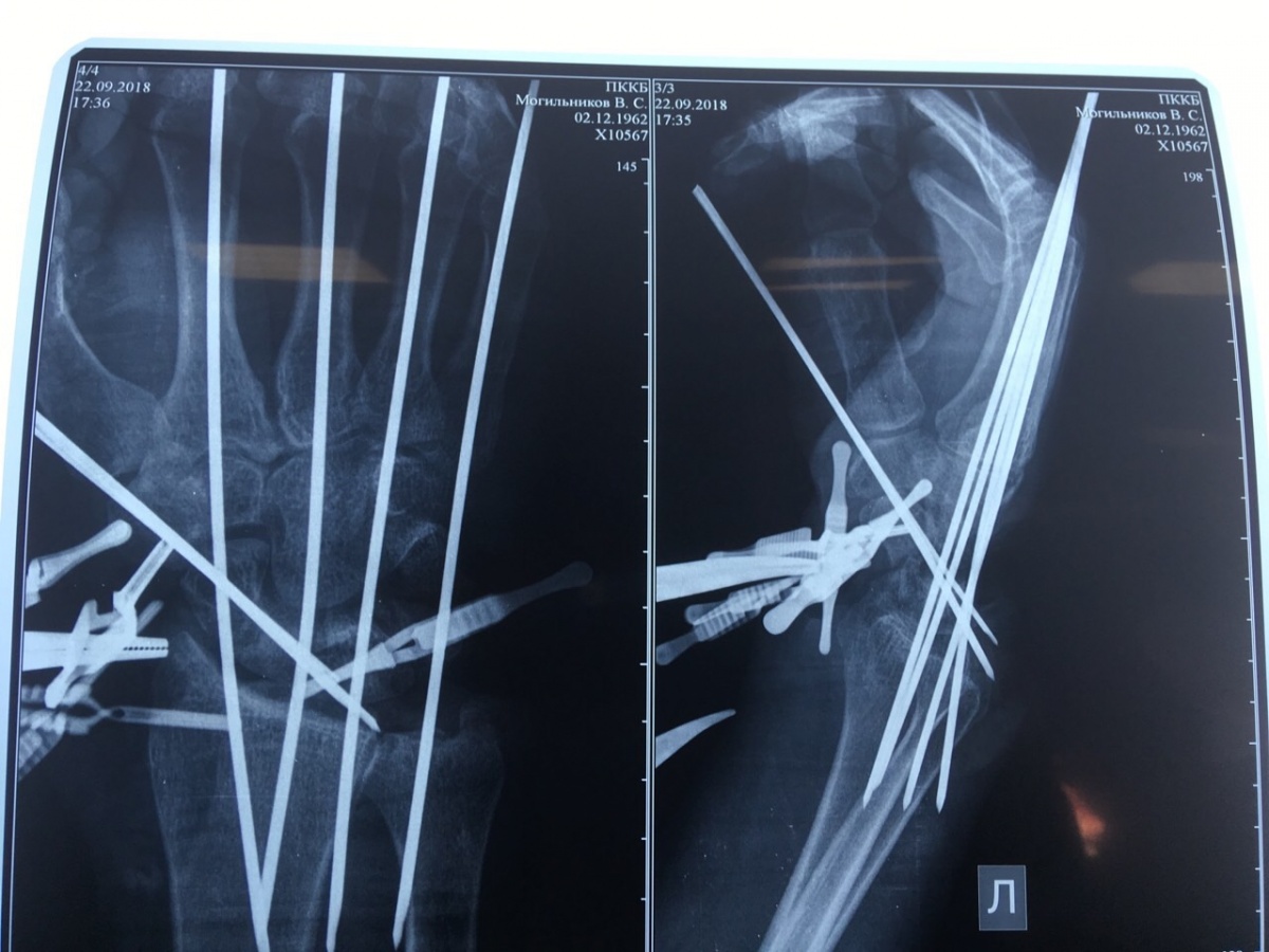 В Перми врачи пришли мужчине отрубленную топором руку