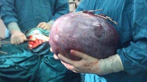 Подмосковные хирурги удалили пациентке 15-килограммовую опухоль