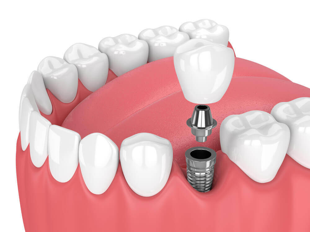 Потеря жевательных зубов — это не столько эстетическая проблема, сколько серьезная проблема для здоровья. Из-за невозможности тщательно пережевывать пищу возникают проблемы с пищеварением, а изменение прикуса не только меняет черты лица, но и может вызывать головные боли. Восстановить поврежденный зуб поможет металлокерамическая коронка на импланте, рассказали специалисты Esthetic Classic Dent, клиники имплантологии и эстетической стоматологии Доктора Шматова.