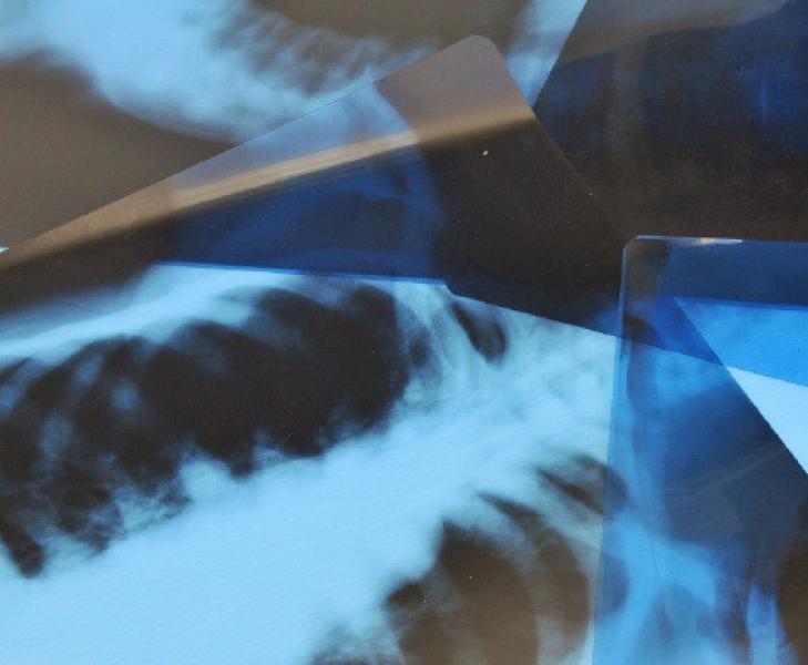 «SONY» и «AGFA» возобновили поставки рентгеновской пленки в РФ