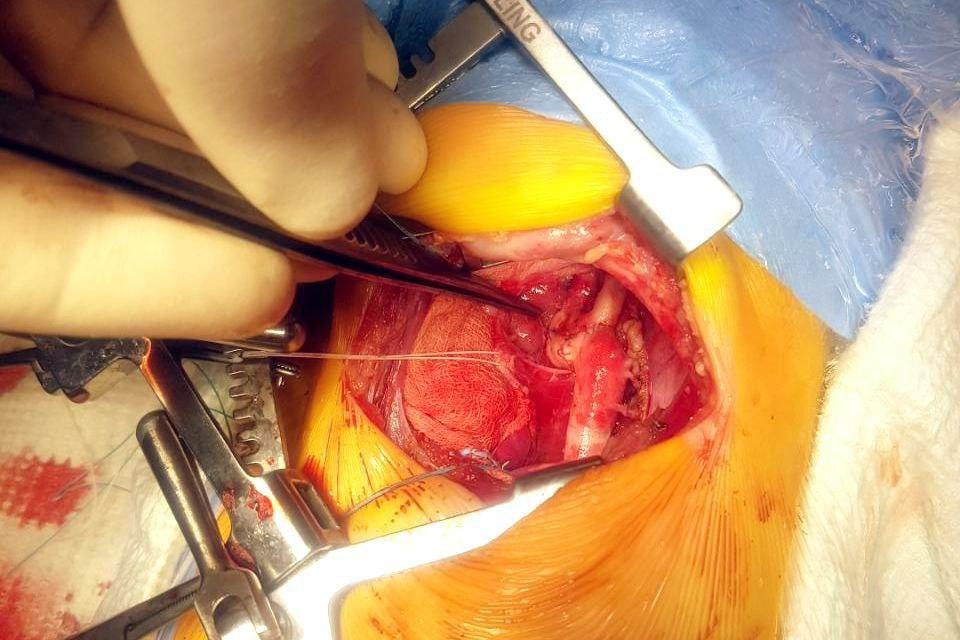 «Бычья дуга аорты» — редчайший порок сердца успешно прооперировали детские кардиохирурги ФГБУ «НМИЦ им. В. А. Алмазова» 3