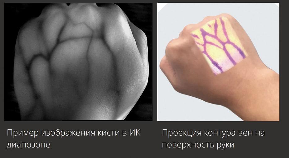 Российские студенты создали визуализатор вен, который упрощает пункцию пациентам с труднодоступными сосудами