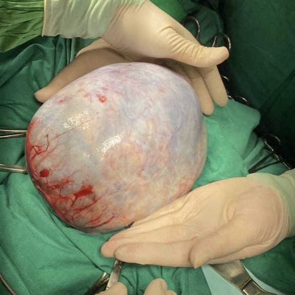 Врачи удалили пациентке пограничную опухоль яичника весом 2 кг