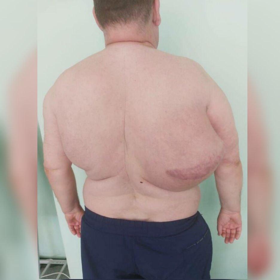 В Подмосковье хирурги удалили липому весом 10кг, которая развивалась 15 лет