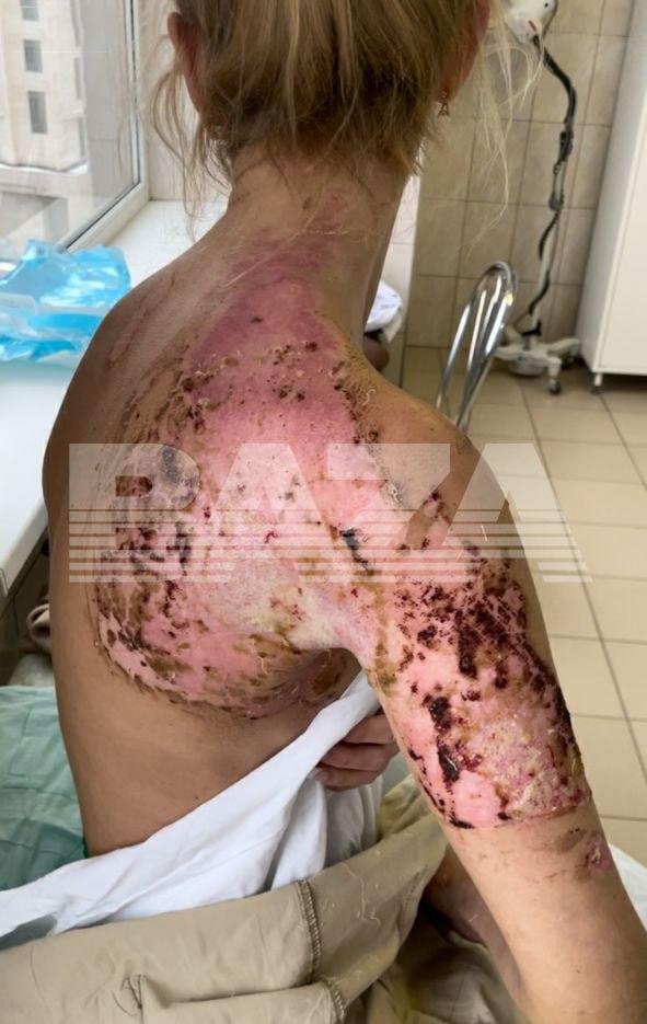 В московской больнице пациентка загорелась на операционном столе – пострадали она и хирург