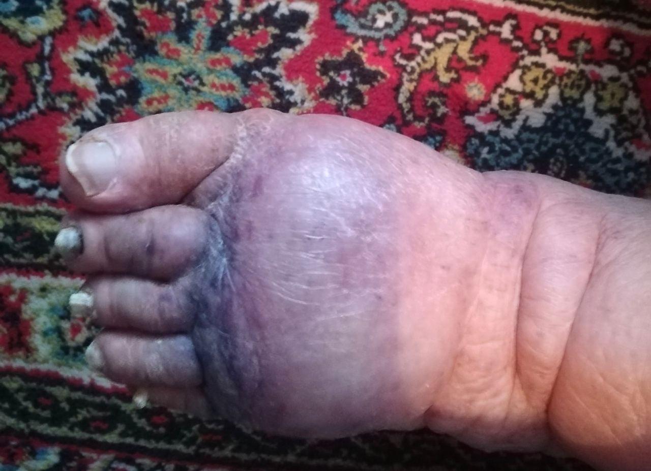 Жительница Кургана обвинила медиков в отказе госпитализировать ее соседку с «синей ногой»