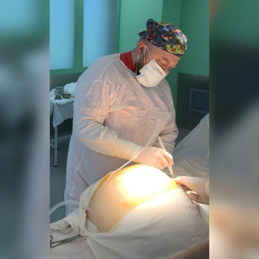 Подмосковные онкологи удалили пациентке 65-сантиметровую злокачественную опухоль весом 17 килограммов