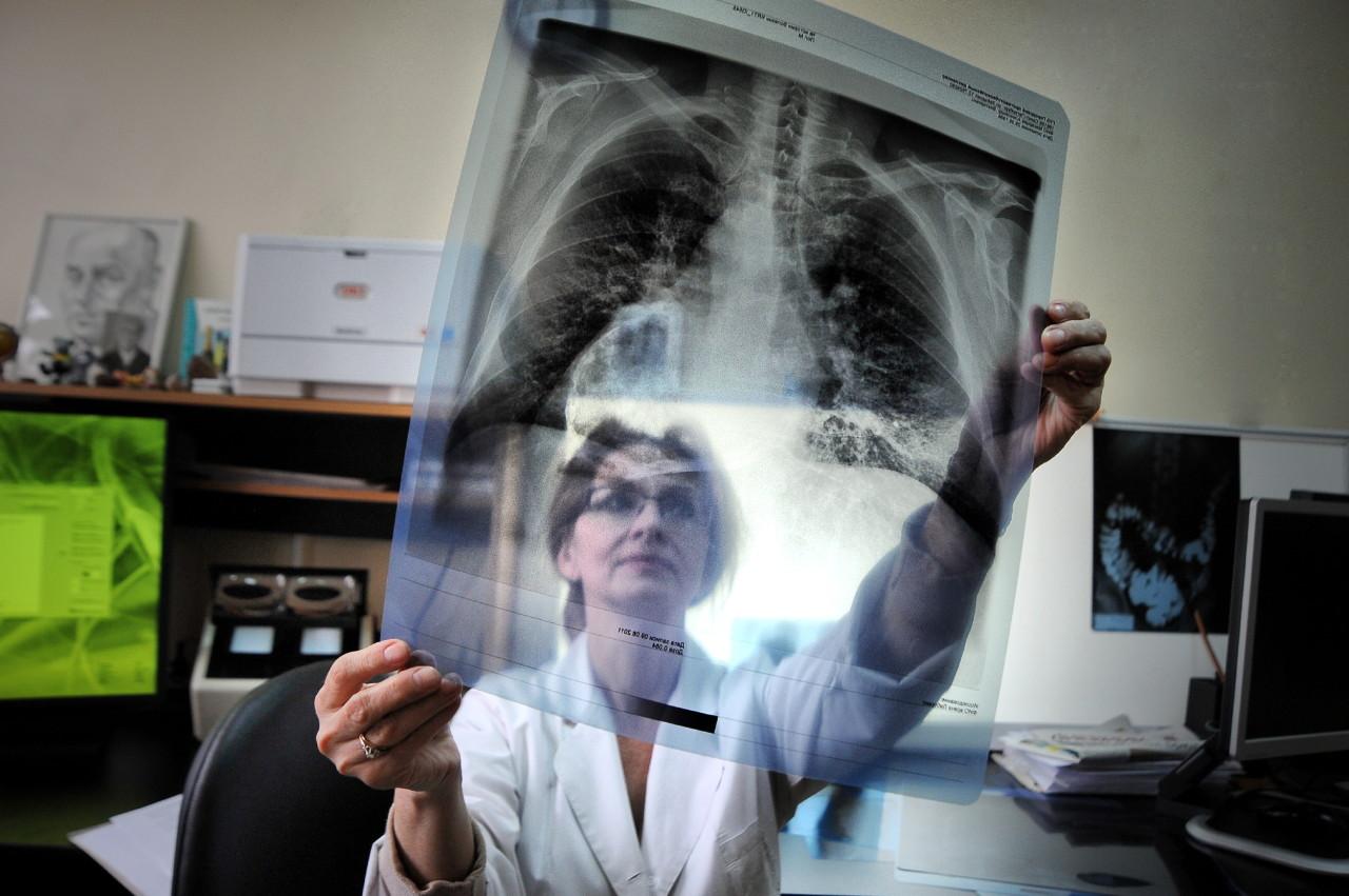 «Лучшие показатели за весь период»: Россия достигла исторического минимума по заболеваемости туберкулёзом