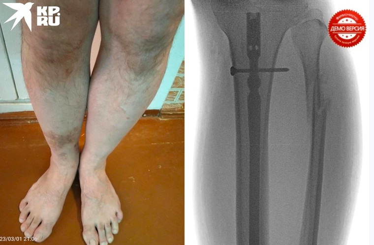 «Нога стала на 1,5 см короче»: мужчина судится с травматологами из-за неправильно вылеченного перелома