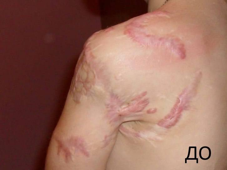 Российские врачи в течение 12 лет спасали руку девочки, на которую напал лев