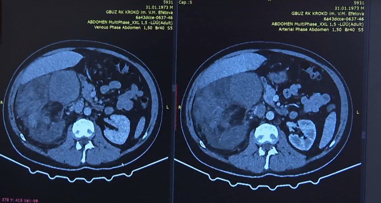 Крымские врачи удалили пациенту огромную злокачественную опухоль с аутотрансплантацией почки