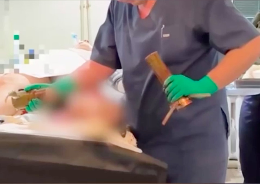 Российские хирурги извлекли из ноги солдата неразорвавшихся снаряд