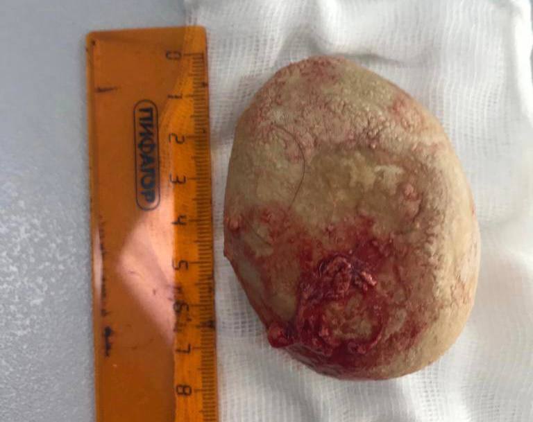 Подмосковные врачи удалили огромный камень из мочевого пузыря мужчины