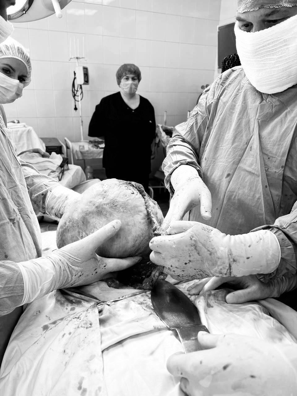 Подмосковные хирурги удалили 40-сантиметровую миому матки пациентке, которая два года не обращалась к врачу