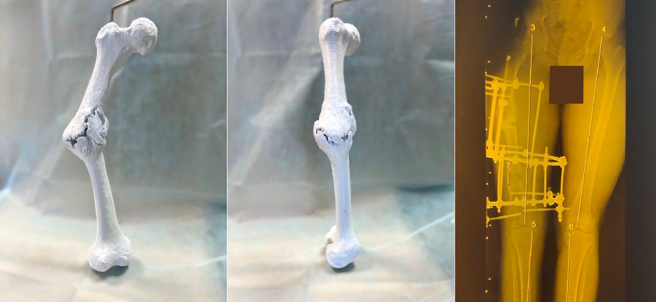Самарские хирурги прооперировали ребенка с ложным суставом при помощи 3D-модели кости