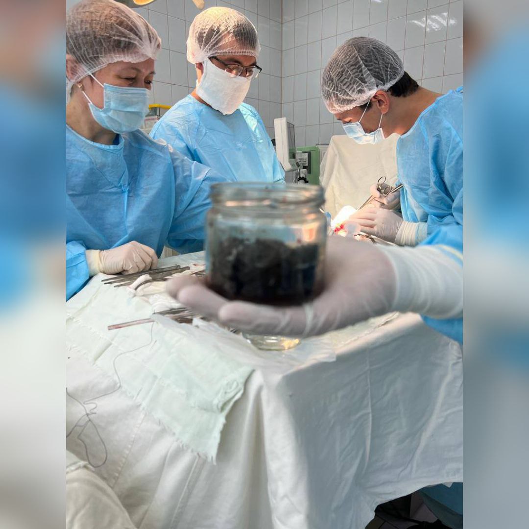 Башкирские хирурги извлекли 300 грамм магнитов из желудка пациента — ими по рецепту из интернета он лечил язвенную болезнь 