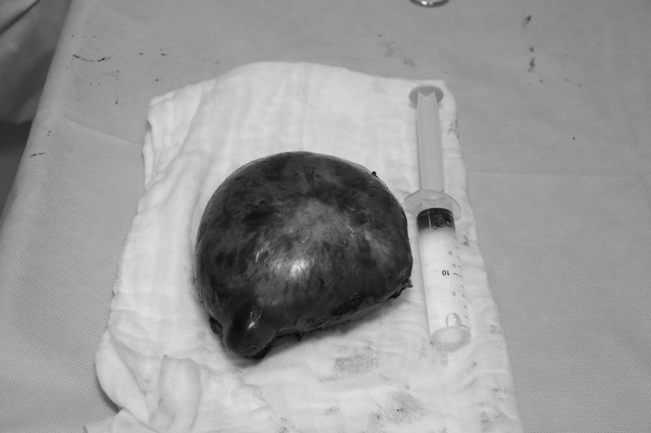 В Кургане мультидисциплинарная бригада из двух центров в восемь рук удаляла пациентке гигантскую опухоль спинного мозга