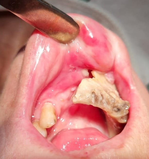 В Татарстане хирурги прооперировали пациентку с остеомиелитом и некрозом нижней челюсти — женщина долго не обращалась к стоматологам