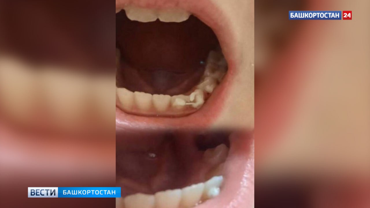 Прокуратура проверит башкирскую стоматологию после сообщения о том, что врач удалил ребенку здоровый зуб, а после вставил его обратно и «прикрепил проволоку»