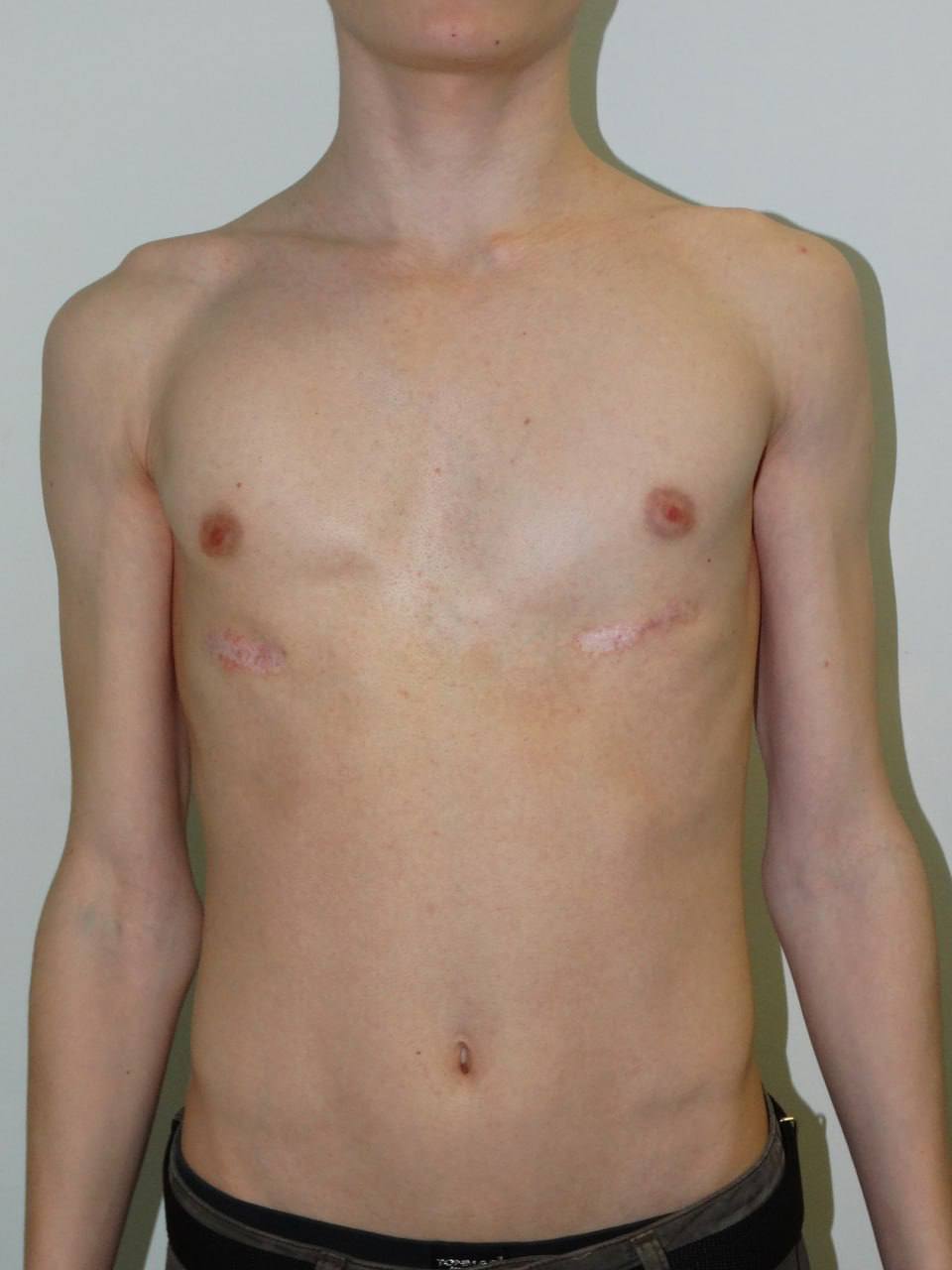 Московские хирурги прооперировали пациента с асимметричной деформацией грудной клетки  2