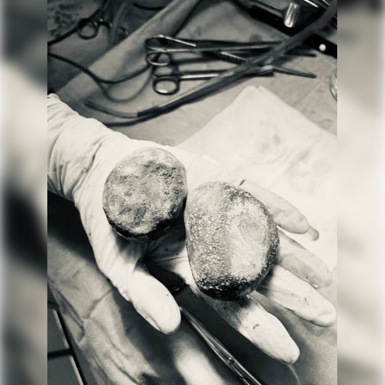 Подмосковные врачи удалили два камня-гиганта из мочевого пузыря пациентки 