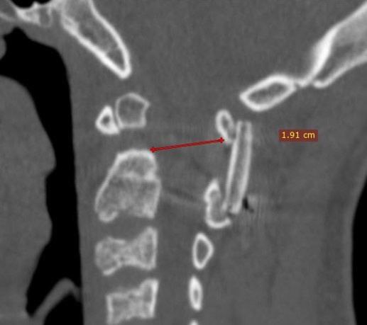 Двенадцатилетний пациент с синдромом Дауна из Калмыкии в октябре поступил в местную больницу с жалобами на прогрессирующую слабость в руках и ногах. В течение двух недель ребенок утратил способность ходить. После проведенного КТ шейного отдела позвоночника специалисты выявили аномалию развития С2, зубовидную кость, вывих С1 и компрессию спинного мозга. Ребенка на реанимобиле перевезли в ФГБУ «НМИЦ ТО им. Н. Н. Приорова». К моменту поступления в стационар у пациента началось нарушение дыхания.