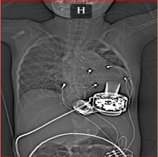 Пермские врачи впервые в мире имплантировали систему механической поддержки левого желудочка сердца трехлетней пациентке 5