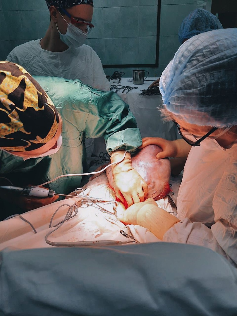 Томские хирурги полностью удалили огромную аденокарциному пожилой пациентке