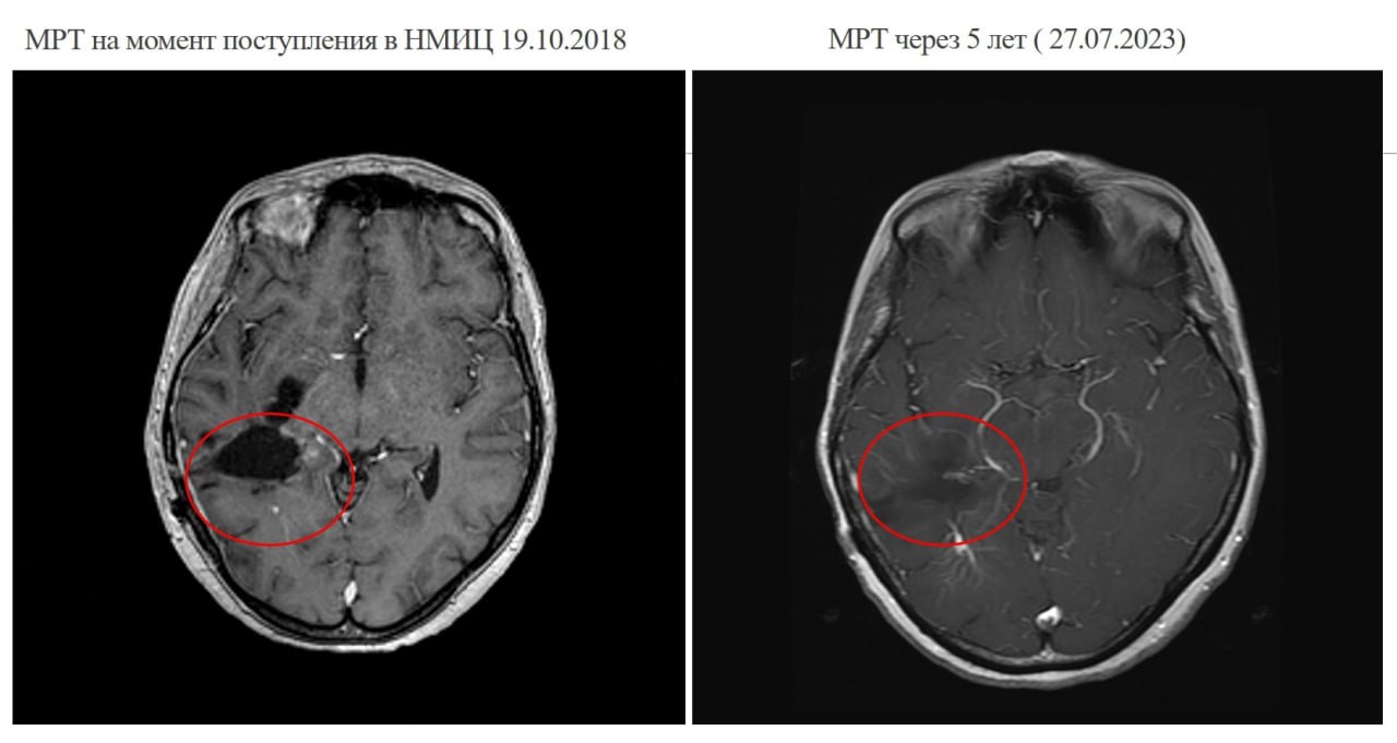 48-летней жительнице Кемеровской области в 2018 году поставили диагноз «глиобластома» – наиболее злокачественная опухоль мозга, для которой характерен стремительный диффузный рост и глубокое внедрение в здоровые окружающие ткани мозга. По словам специалистов, полное удаление такой опухоли практически невозможно, так как до 10% микроскоплений её клеток может находиться на расстоянии от основного узла и даже в другом полушарии мозга. При таком диагнозе пациентам удаляют максимально возможную часть опухоли, а далее проводят курсы химиолучевой терапии с большими «отступами» в сторону здоровых тканей.