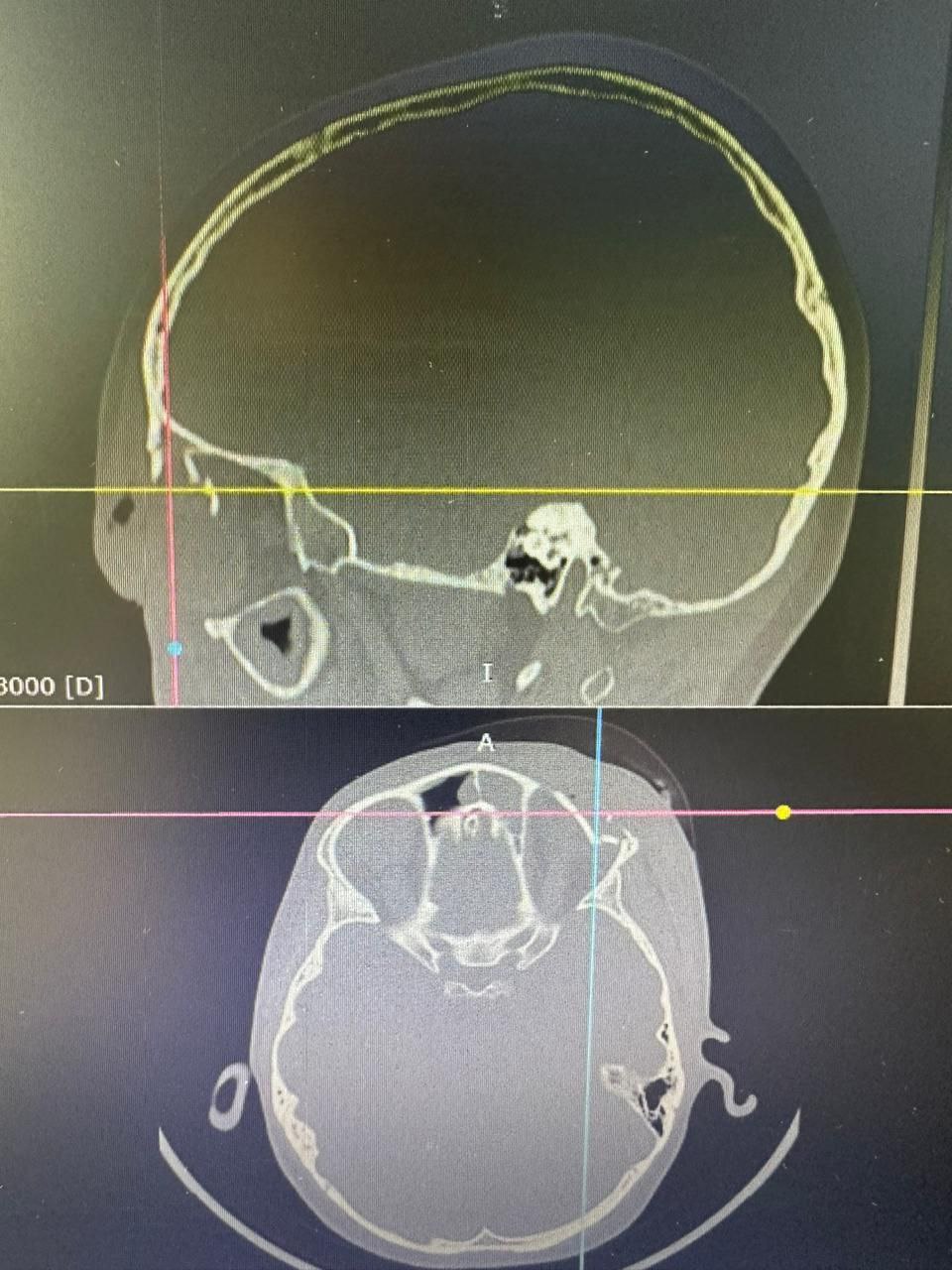 В приемно-диагностическое отделение ГАУЗ «Детская республиканская клиническая больница» г. Улан-Удэ доставили девятилетнего мальчика, которого конь лягнул в лоб, чуть выше глаза. Ребенок предъявлял жалобы на двоение в глазах и головную боль. На МРТ выявили перелом костей черепа в надглазничной области со смещением глазного яблока. Существовал высокий риск перфорации, поскольку осколки верхней стенки орбиты находились очень близко к глазу, один из отломков — в миллиметре.