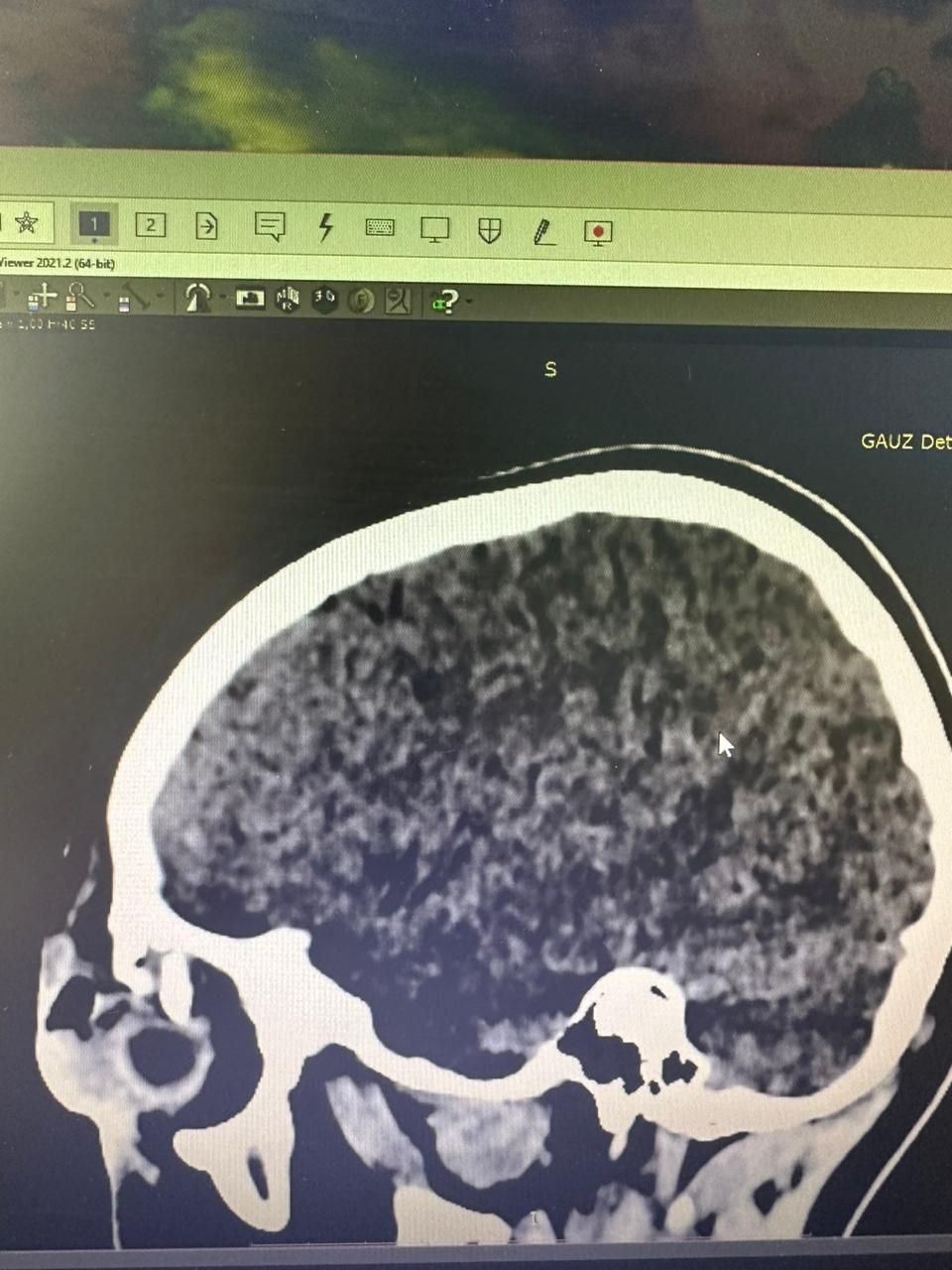 В приемно-диагностическое отделение ГАУЗ «Детская республиканская клиническая больница» г. Улан-Удэ доставили девятилетнего мальчика, которого конь лягнул в лоб, чуть выше глаза. Ребенок предъявлял жалобы на двоение в глазах и головную боль. На МРТ выявили перелом костей черепа в надглазничной области со смещением глазного яблока. Существовал высокий риск перфорации, поскольку осколки верхней стенки орбиты находились очень близко к глазу, один из отломков — в миллиметре.
