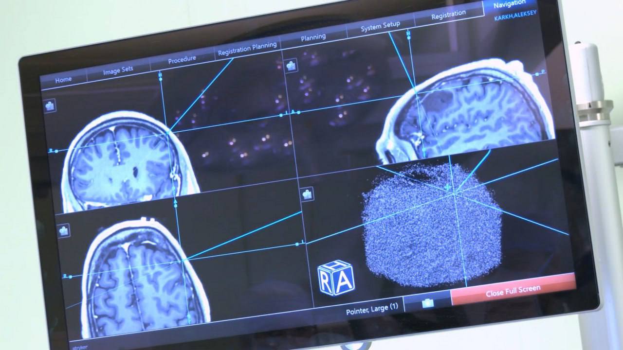 Новосибирские врачи выполнили уникальную операцию, которая помогла сохранить функцию речи после удаления опухоли головного мозга