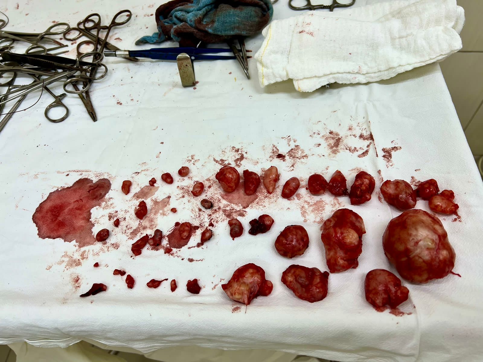 Хирурги НИИАП Ростова-на-Дону удалили 40 опухолей на матке пациентки во время кесарева сечения