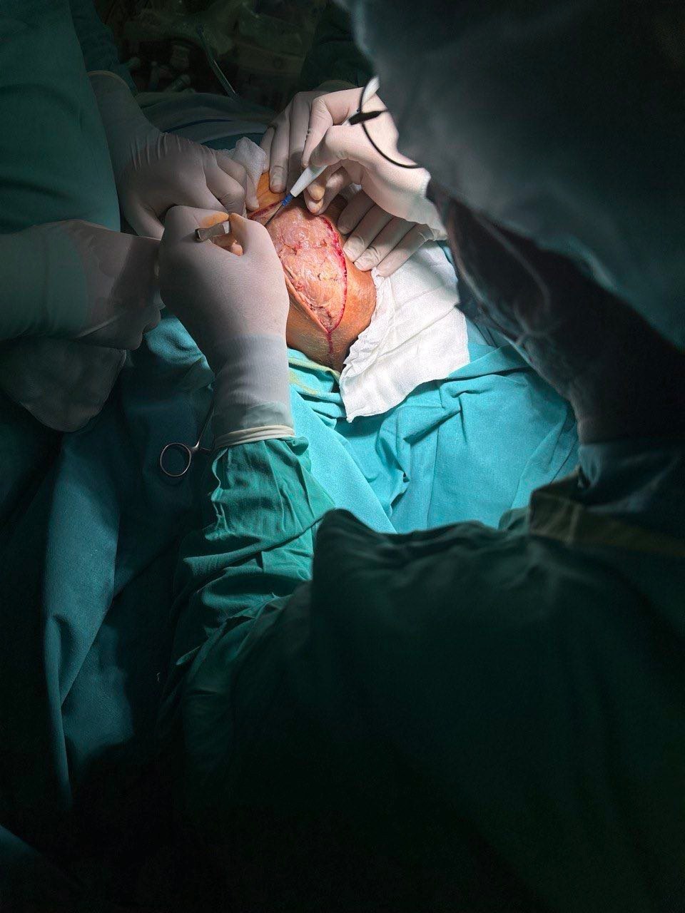 Московские хирурги прооперировали пациентку с необычной кистой-«хвостом» 3