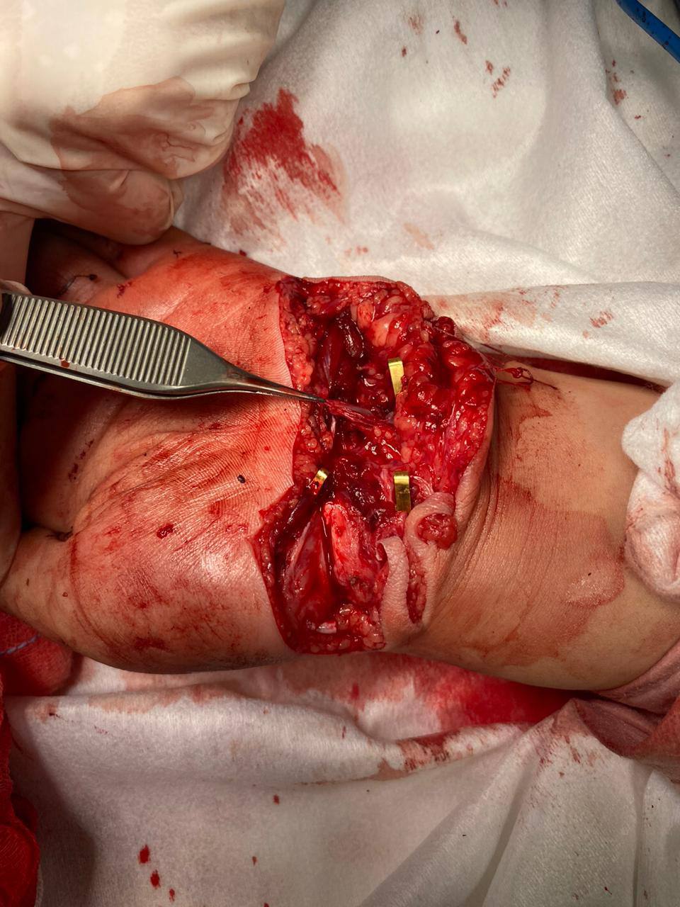 Микрохирурги Педиатрического университета 10 часов оперировали ребёнка, рука которого попала в блендер 2
