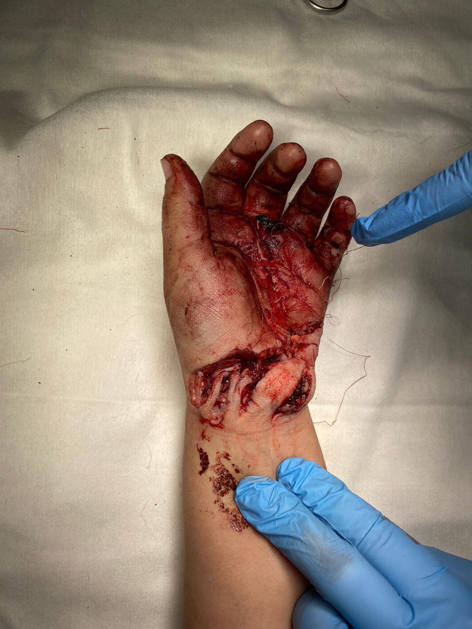 Микрохирурги Педиатрического университета 10 часов оперировали ребёнка, рука которого попала в блендер