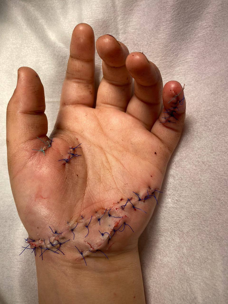 Микрохирурги Педиатрического университета 10 часов оперировали ребёнка, рука которого попала в блендер 4
