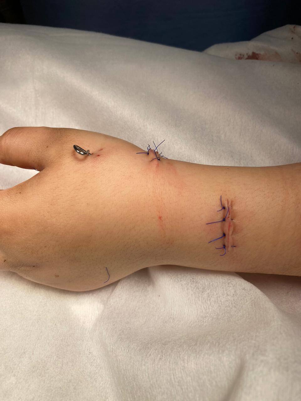 Микрохирурги Педиатрического университета 10 часов оперировали ребёнка, рука которого попала в блендер 5