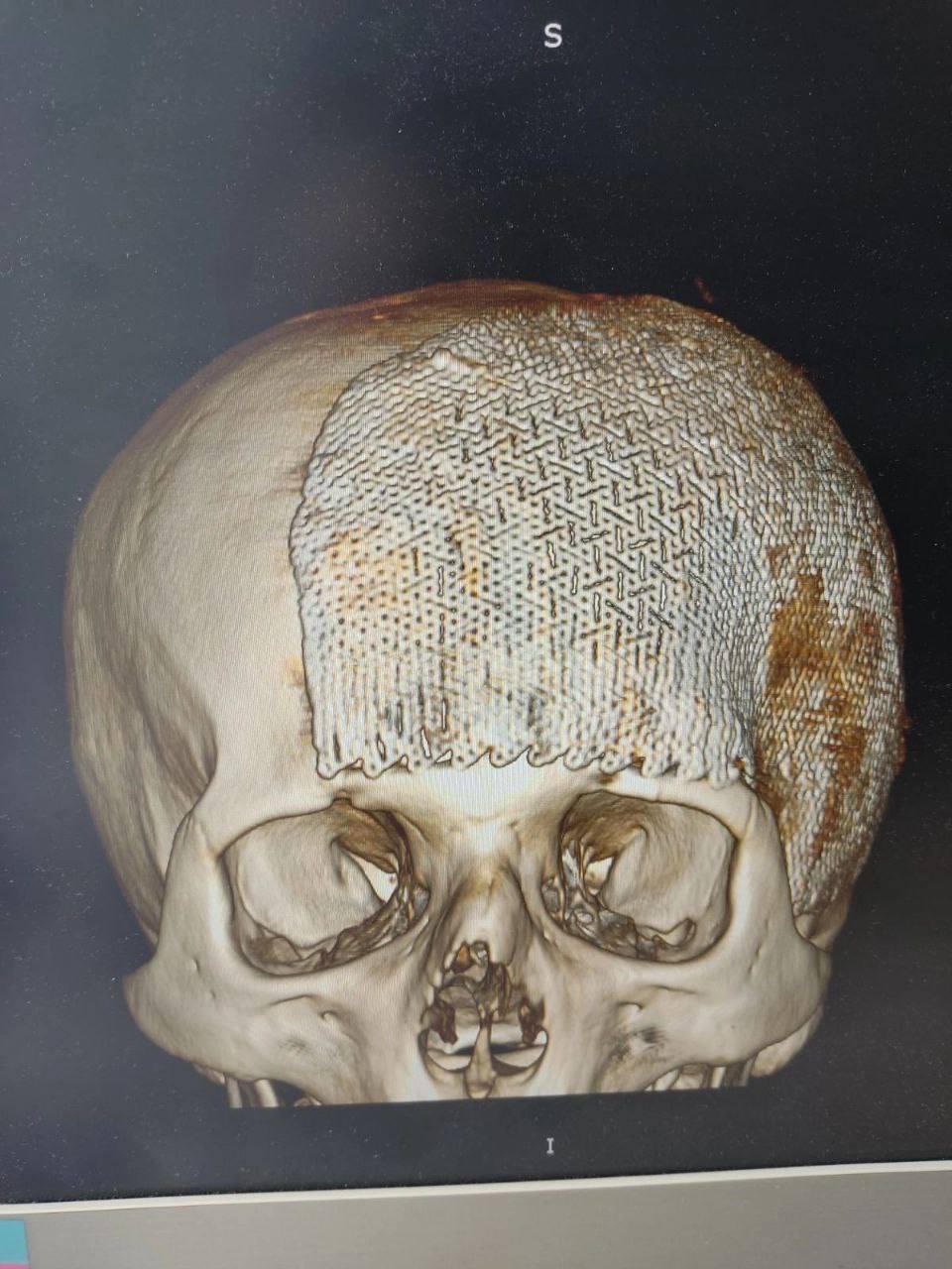 Тюменские нейрохирурги восстановили пациенту половину черепа с помощью 3D-технологий 3