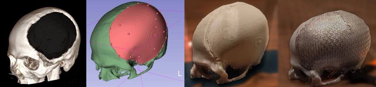 Тюменские нейрохирурги восстановили пациенту половину черепа с помощью 3D-технологий