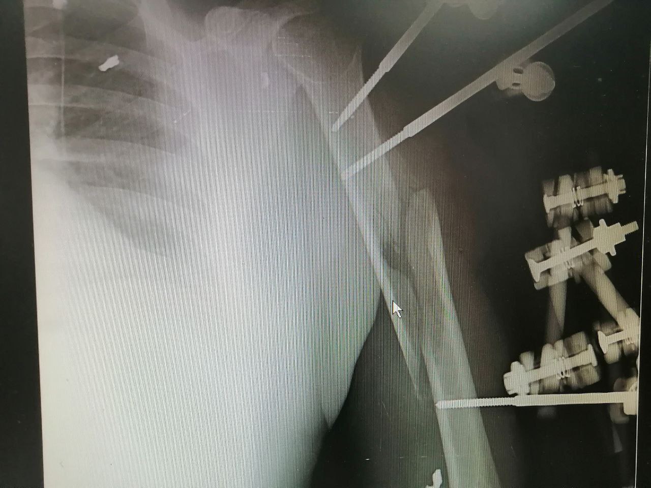 Врачи из Сургута восстановили поврежденную руку бойцу СВО - пересадили 4-сантиметровый фрагмент нерва из голени в плечо 3