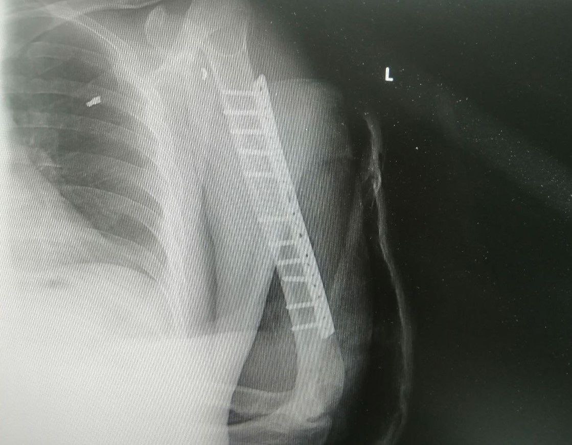 Врачи из Сургута восстановили поврежденную руку бойцу СВО - пересадили 4-сантиметровый фрагмент нерва из голени в плечо 5