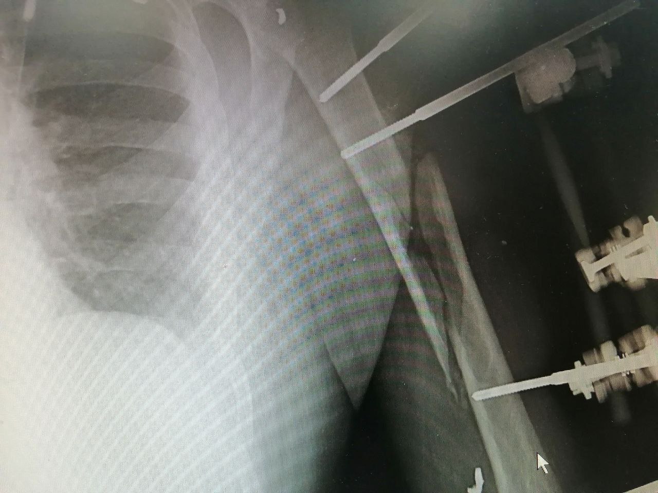 Врачи из Сургута восстановили поврежденную руку бойцу СВО - пересадили 4-сантиметровый фрагмент нерва из голени в плечо 4
