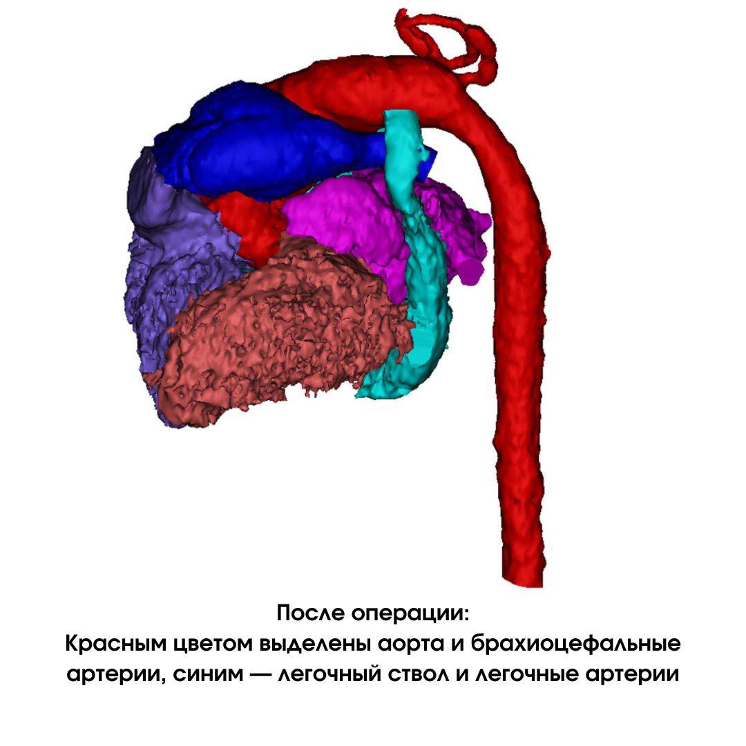Новосибирские кардиохирурги прооперировали новорожденного с несовместимыми с жизнью пороками сердца 3