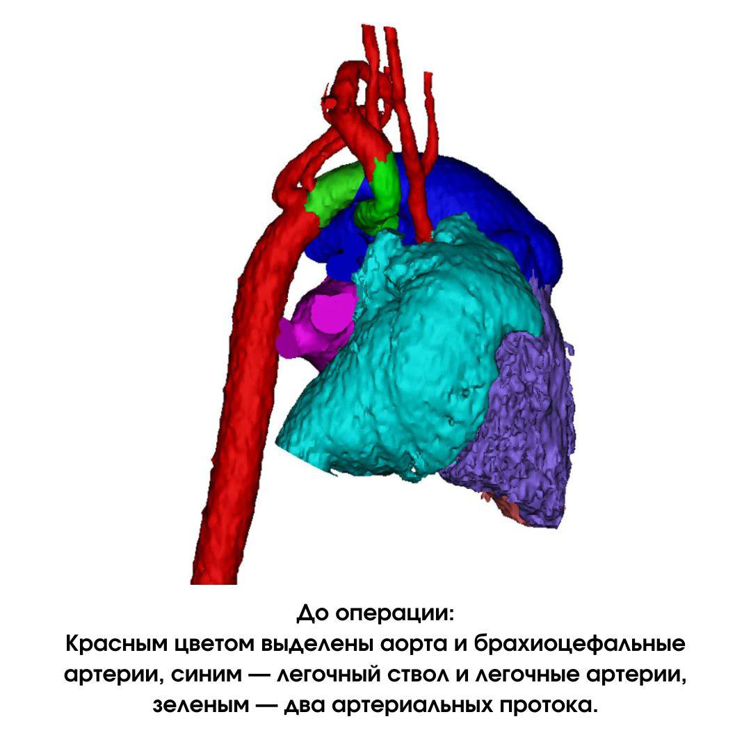 Новосибирские кардиохирурги прооперировали новорожденного с несовместимыми с жизнью пороками сердца 2
